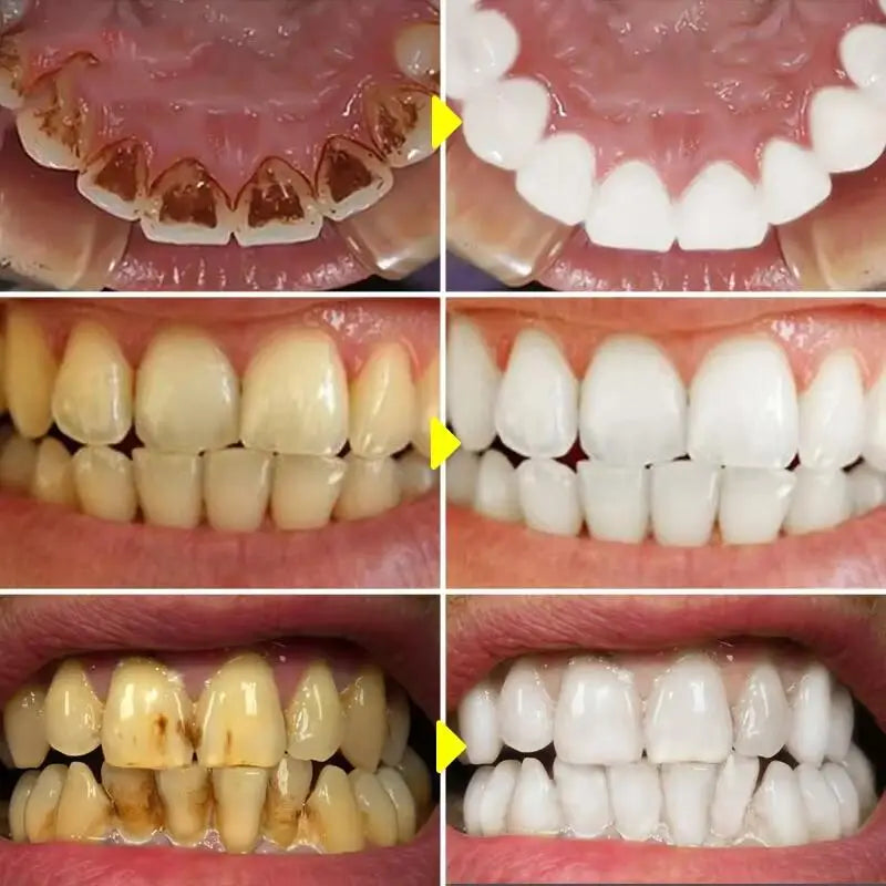 5 Days Teeth Whitening Powder – Removes Plaque, Stains & Dental Calculus for a Brighter, Fresher Smile