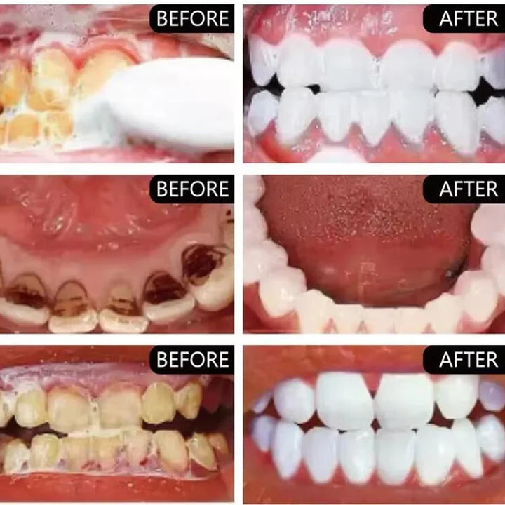 5 Days Teeth Whitening Powder – Removes Plaque, Stains & Dental Calculus for a Brighter, Fresher Smile